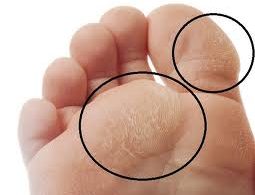 Home Remedies for Calluses on Feet