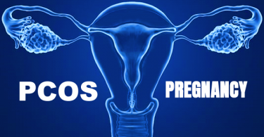PCOS and pregnancy- Women with PCOS can struggle to become pregnant and are at higher risk of developing complications during pregnancy.
