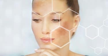 Melasma Causes: Understanding the Root of the Skin Condition